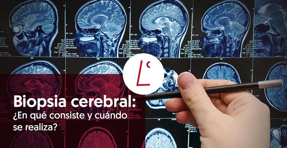 Lo que necesitas saber sobre la biopsia cerebral - Lescer