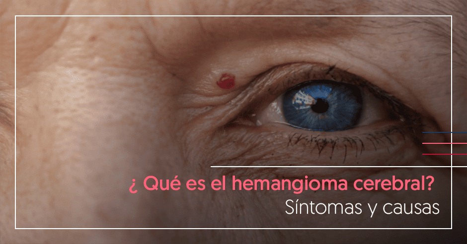 Hemangioma cerebral
